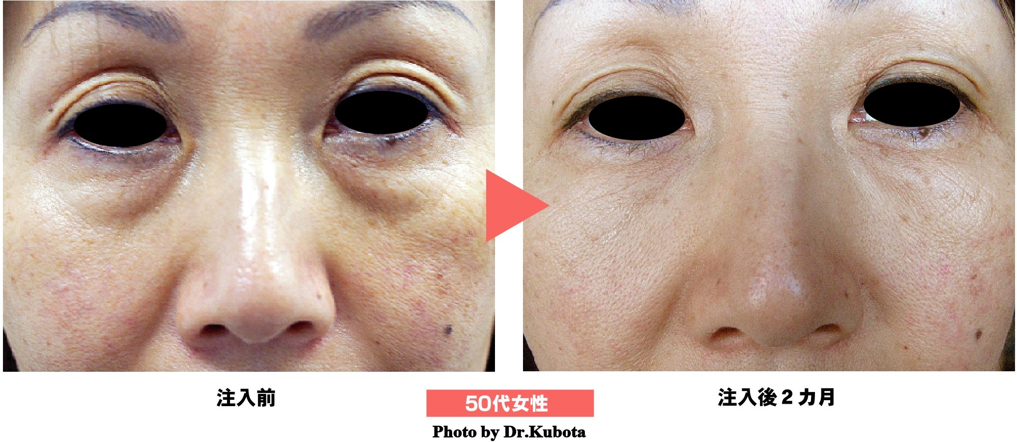 Prp Skin Treatment Before And After - your magazine lite