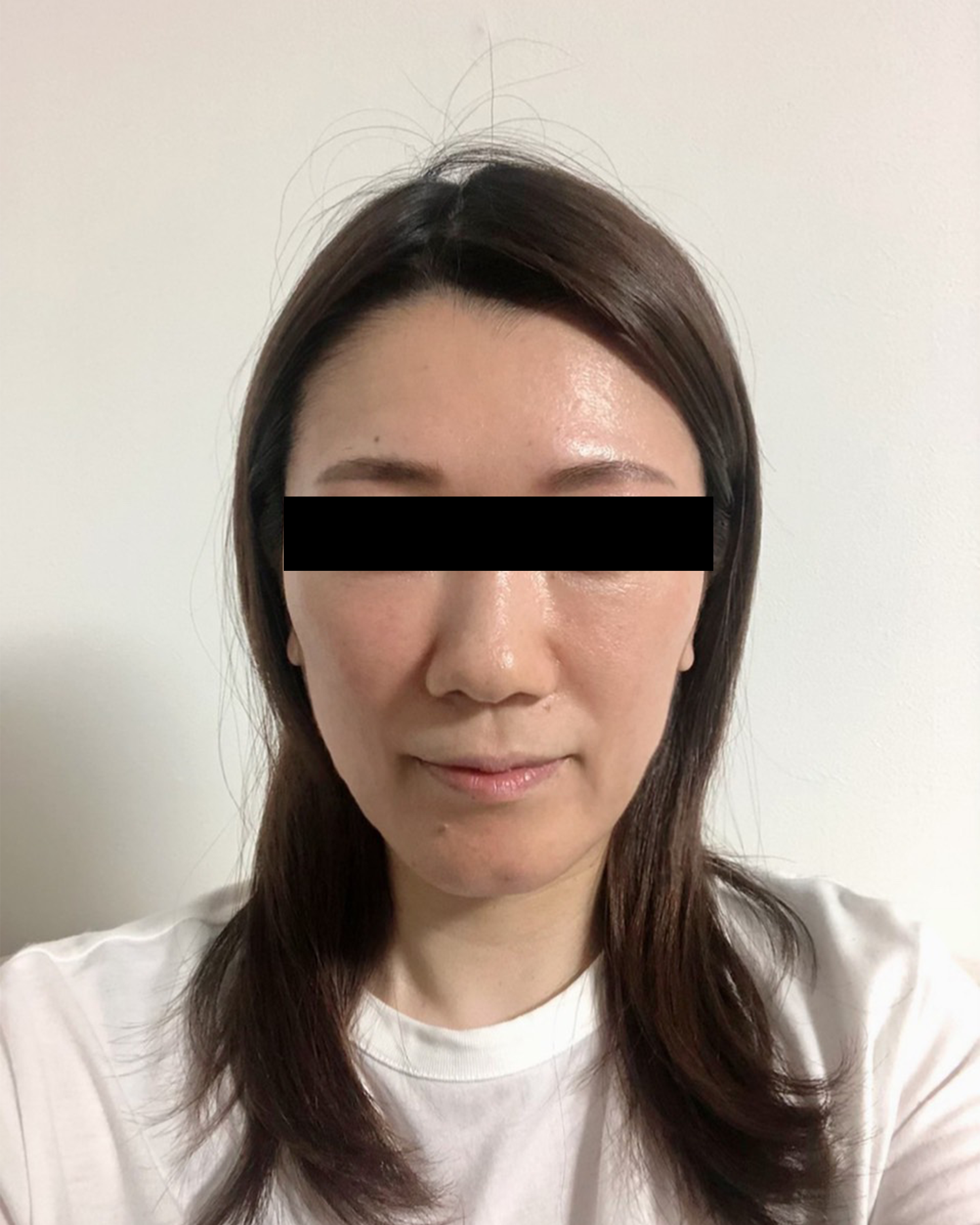 ボトックス注射 ヒアルロン酸注入 千里中央スキンクリニック 皮膚科美容皮膚科 ボトックス注射 ヒアルロン酸注入 千里中央スキンクリニック 皮膚科美容皮膚科